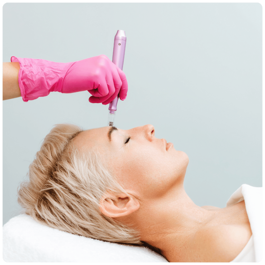 Kosmetik Microneedling Behandlung